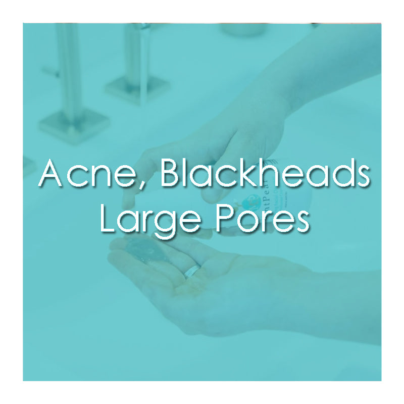 ACNE/BLACKHEADS/LARGE PORES